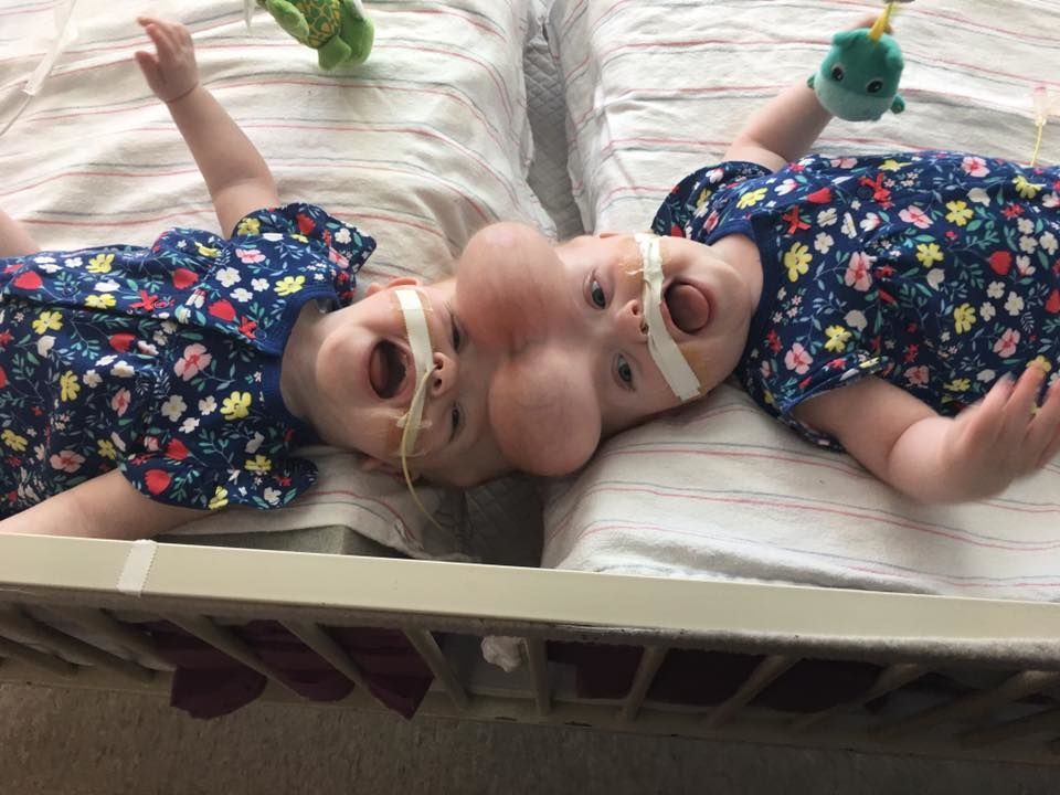 В США провели уникальную операцию по разделению сиамских близнецов с одной головой